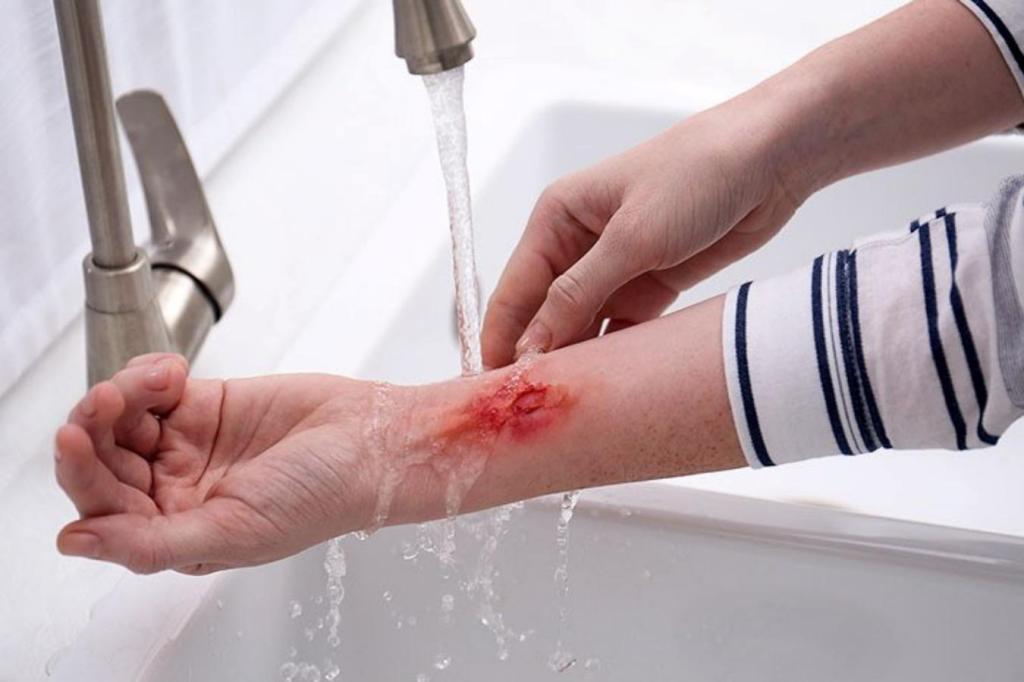 Pertolongan Pertama Pada Luka&nbsp;Bakar