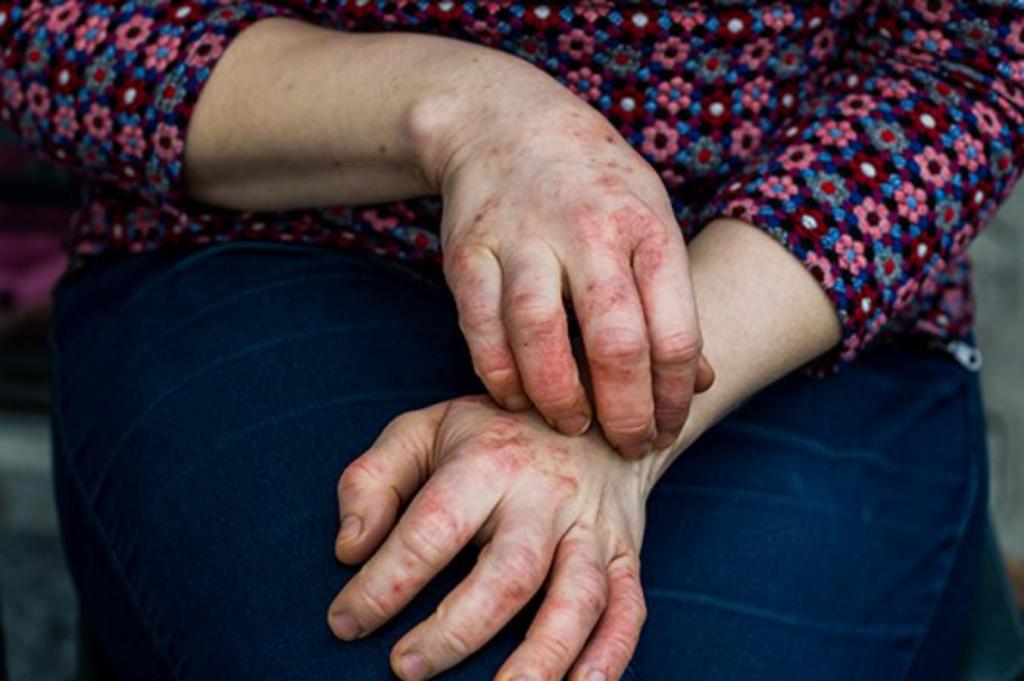 Eksim: 5 Pengobatan Rumahan yang Ampuh dan Patut&nbsp;Dicoba